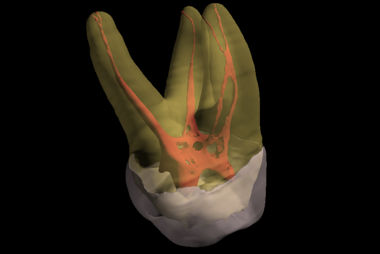 3D Imaging : Complexity of Canals