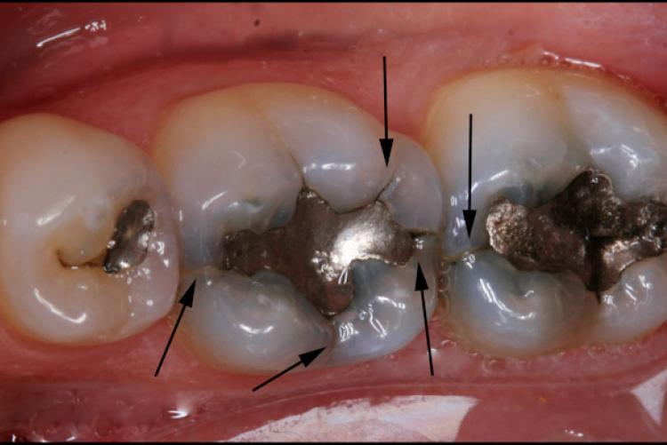 Crack Tooth Syndrome