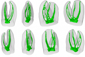Anatomical Complexity: Challenges In Root Canal Therapy